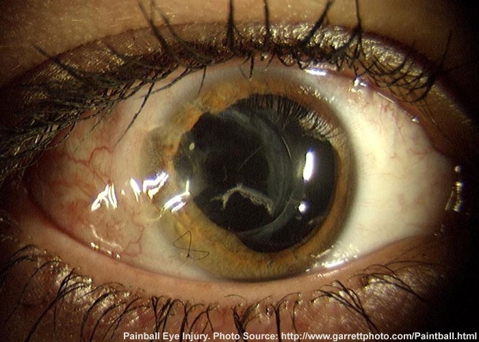 Playing Fast And Loose With Facts On Airsoft And Paintball Injuries